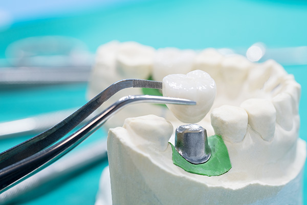General Dentistry Solutions Using Dental Crowns from Miami Smile Dental in Miami, FL